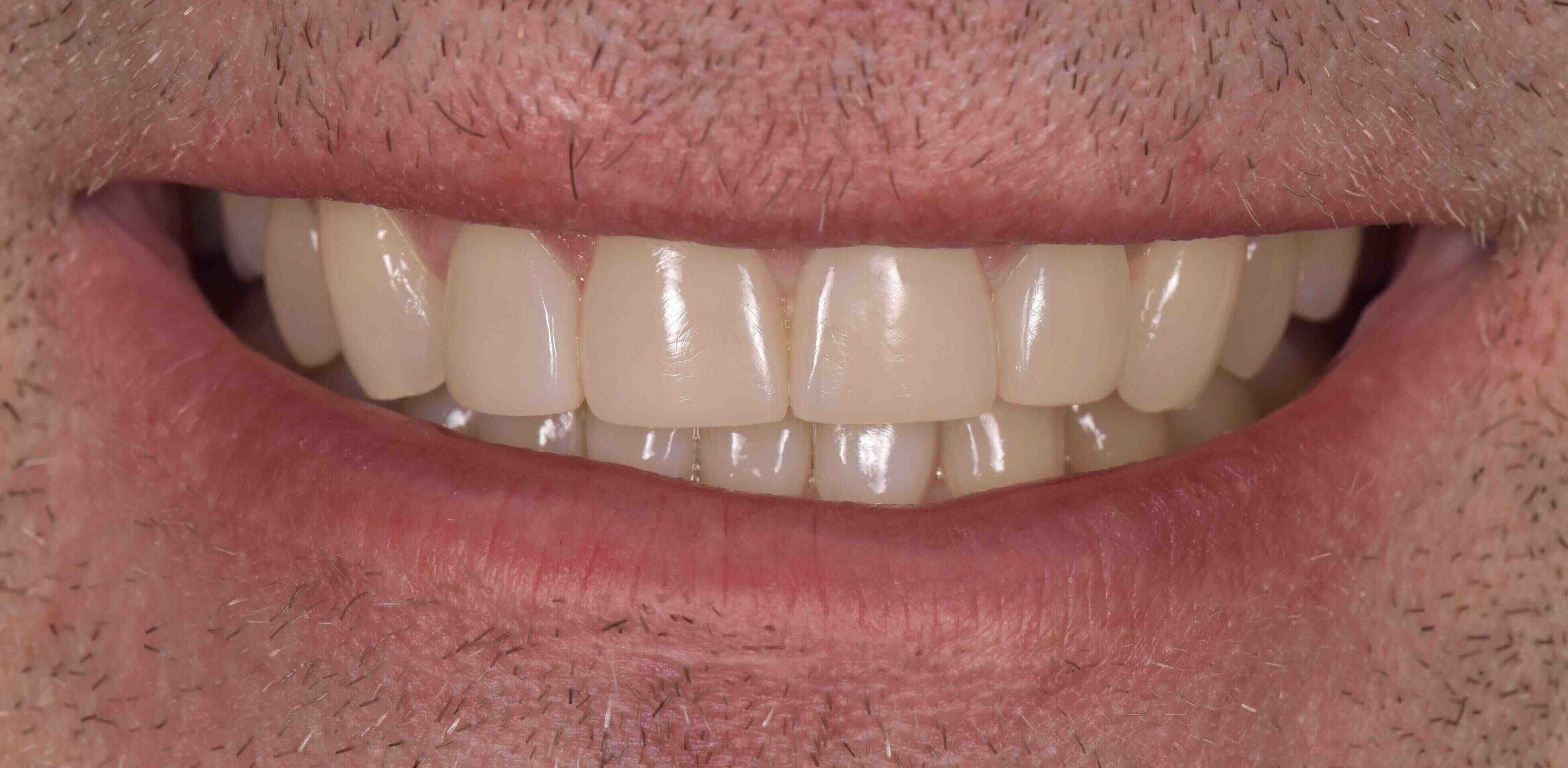 Invisalign and whitening transformation